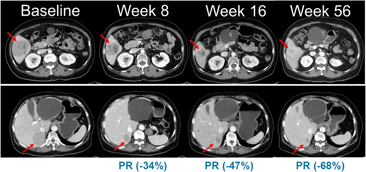 Abdominal CT images showing changes in tumor lesions over time in a clinical trial of combination therapy with belvarafenib and cobimetinib in patients with NRAS-mutant melanoma. (Source: Oral presentation at the American Society of Clinical Oncology [ASCO] Annual Meeting, 2021)